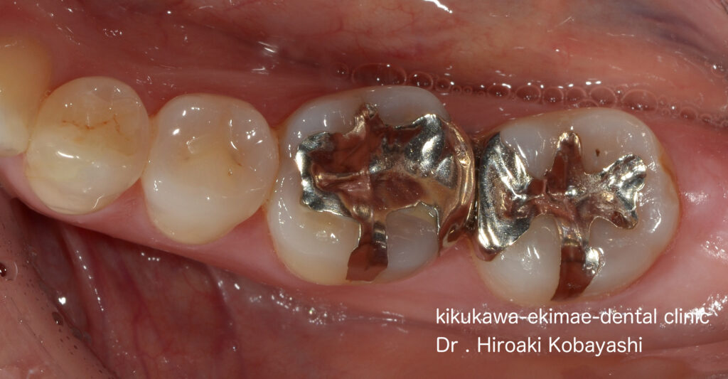 自分の歯を削らず銀歯を白く　ダイレクトボンディグ　Case3｜東京／墨田区／江東区