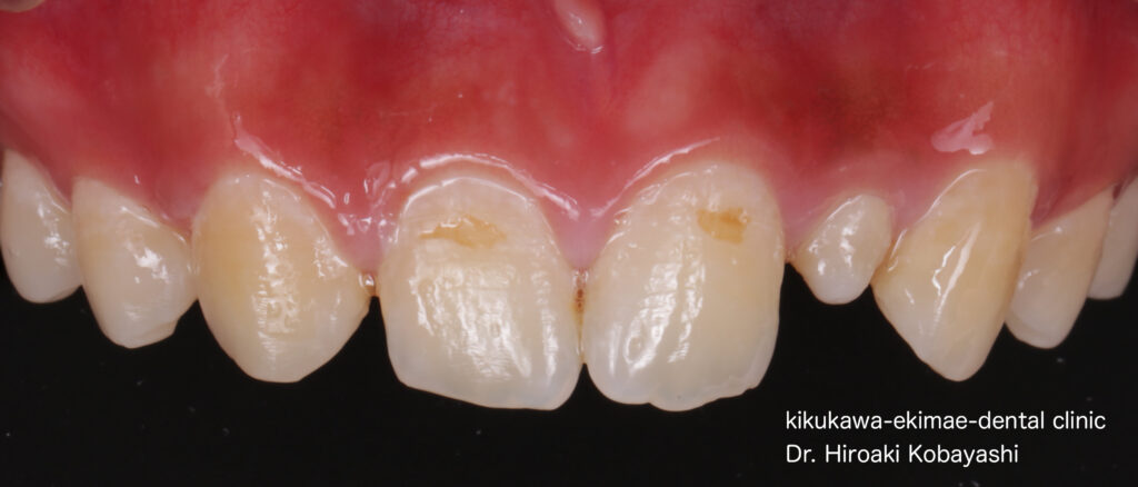 生まれつき小さい歯を削らず1日で改善　ダイレクトボンディング　Case6｜東京／墨田区／江東区