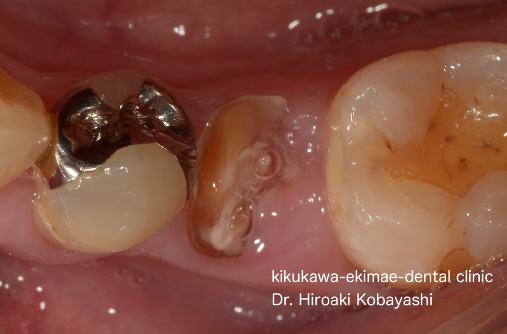 虫歯が大きく抜歯が必要な歯を歯周外科処置により保存　歯周外科治療　Case1｜東京／墨田区／江東区