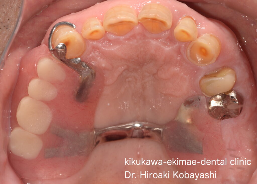 全て金属で出来た入れ歯　入れ歯治療　Case7｜東京／墨田区／江東区