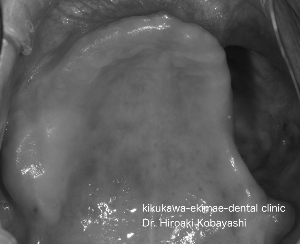 ガンにより骨を大きく失った入れ歯　　入れ歯治療　Case8｜東京／墨田区／江東区