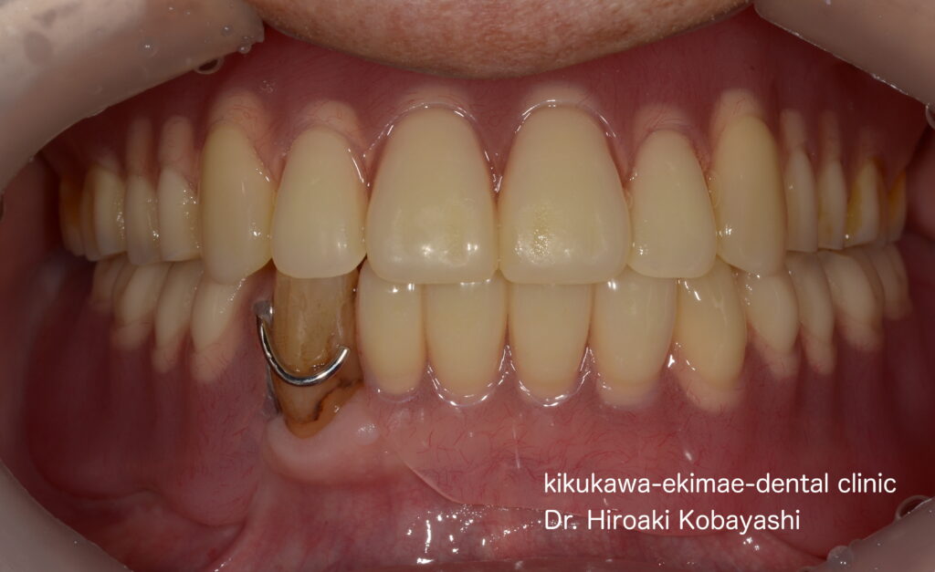 将来を見据えた義歯の設計｜東京／墨田区／江東区