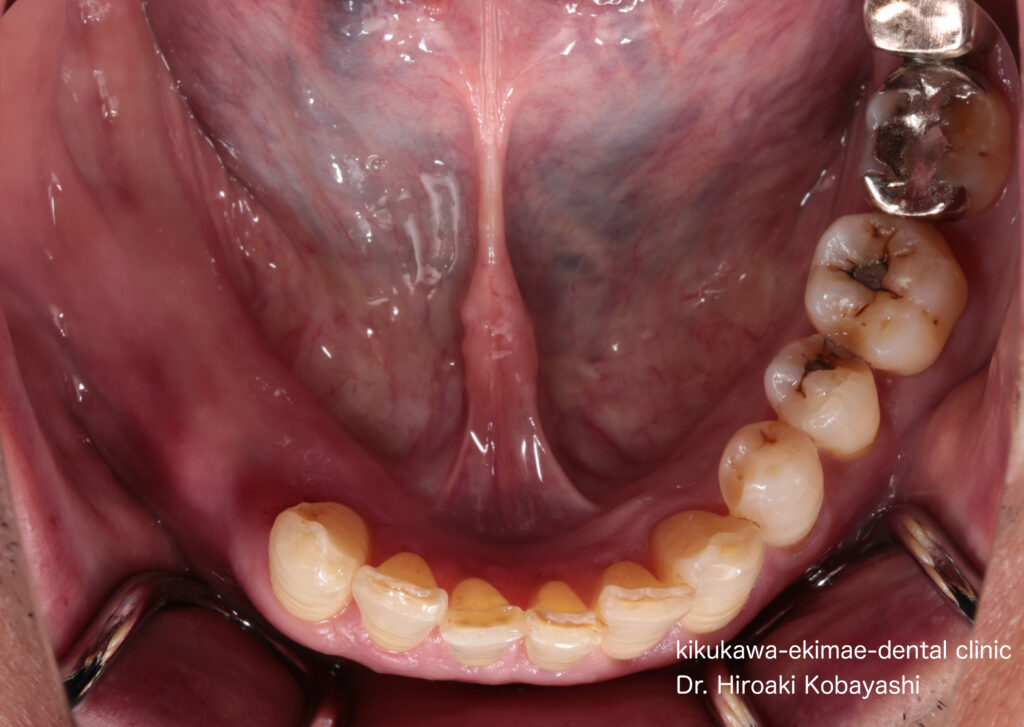部分入れ歯の役割｜東京／墨田区／江東区