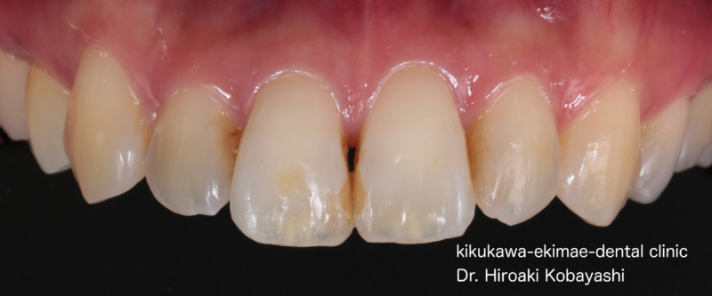 ホームホワイトニングとダイレクトボンディング で前歯の見た目を綺麗に｜東京／墨田区／江東区