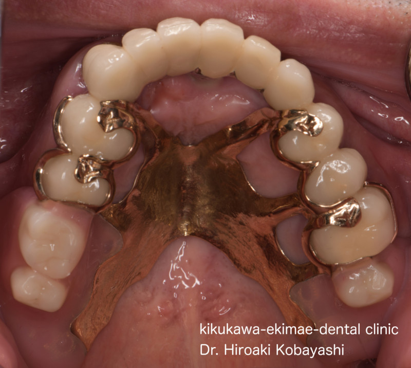 ゴールド床義歯｜東京／墨田区／江東区