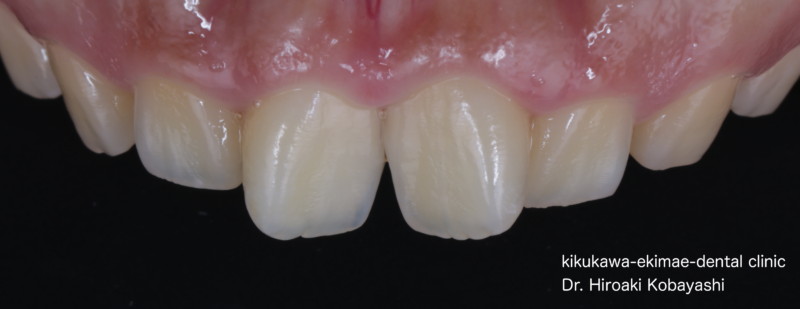 前歯の歯並びを気にされている方は部分矯正がお勧めです。｜東京／墨田区／江東区