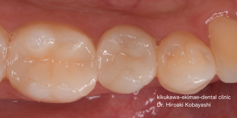 根の治療後のセラミック修復｜東京／墨田区／江東区