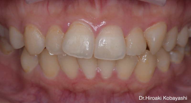 部分矯正による前歯の見た目の改善
