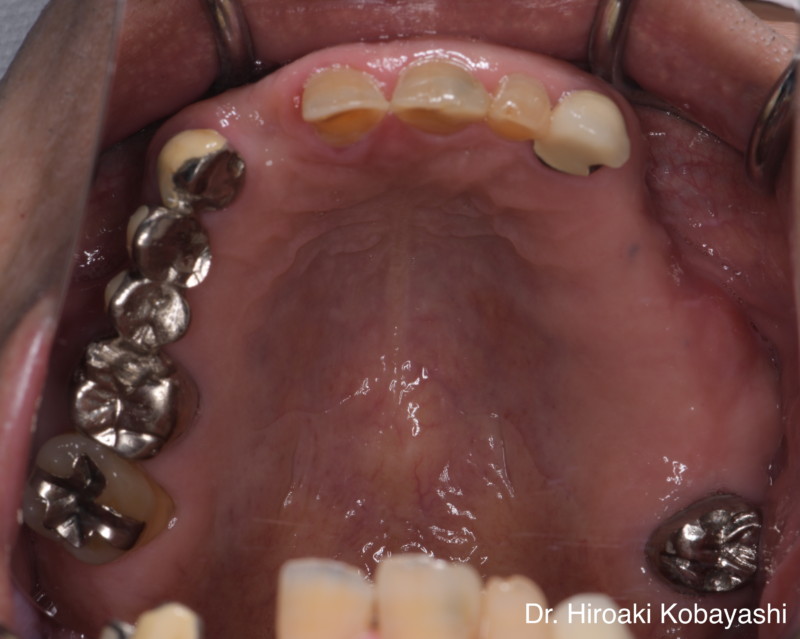 部分金属床義歯による歯の機能回復と歯の保護