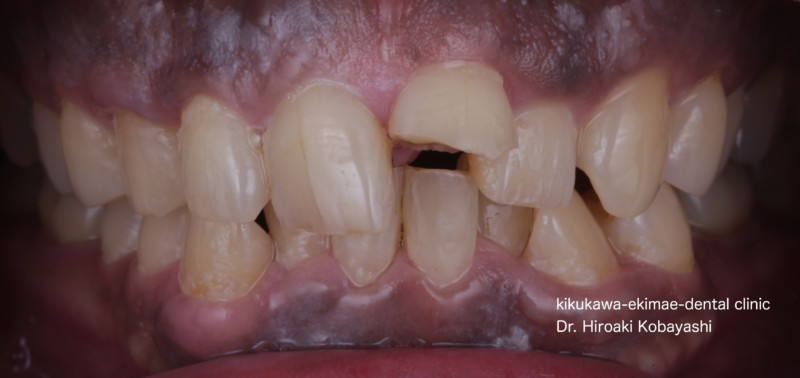 前歯が折れた際の治療