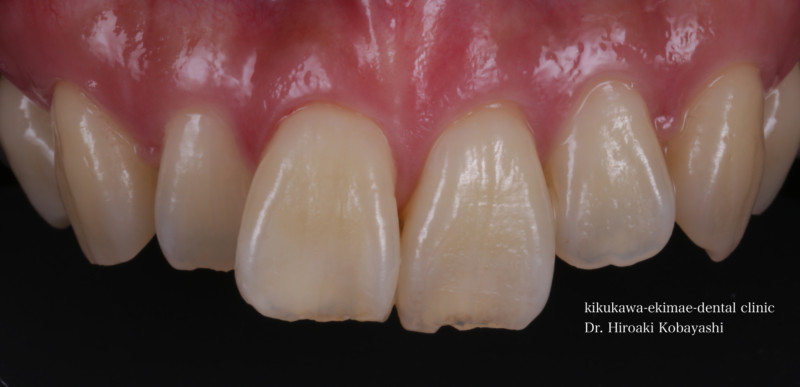 上前歯の部分矯正
