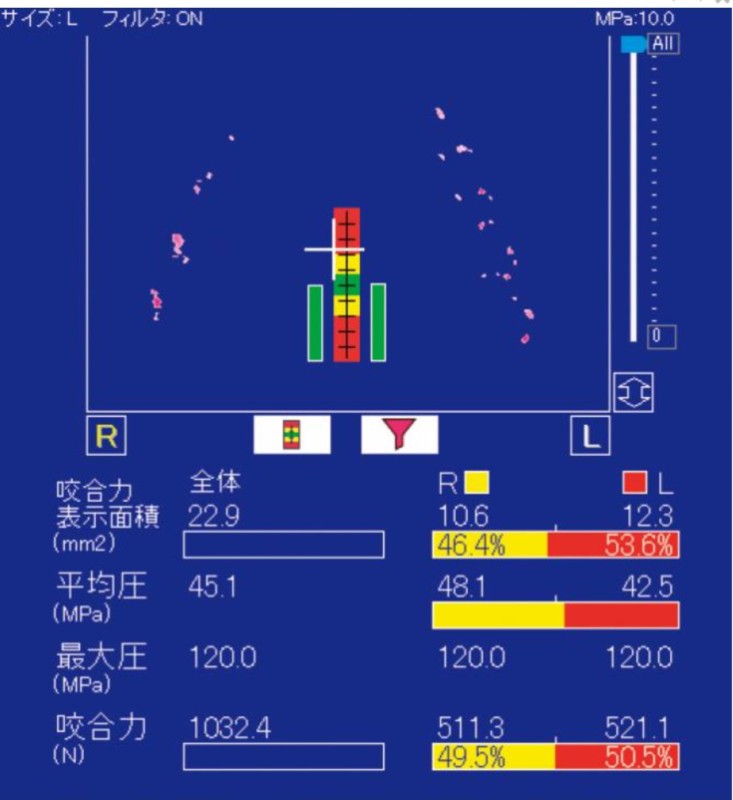 咬合の可視化、デジタル化