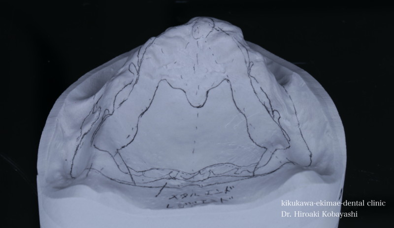 最終義歯の型取り