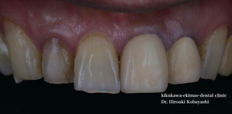 前歯のセラミック治療