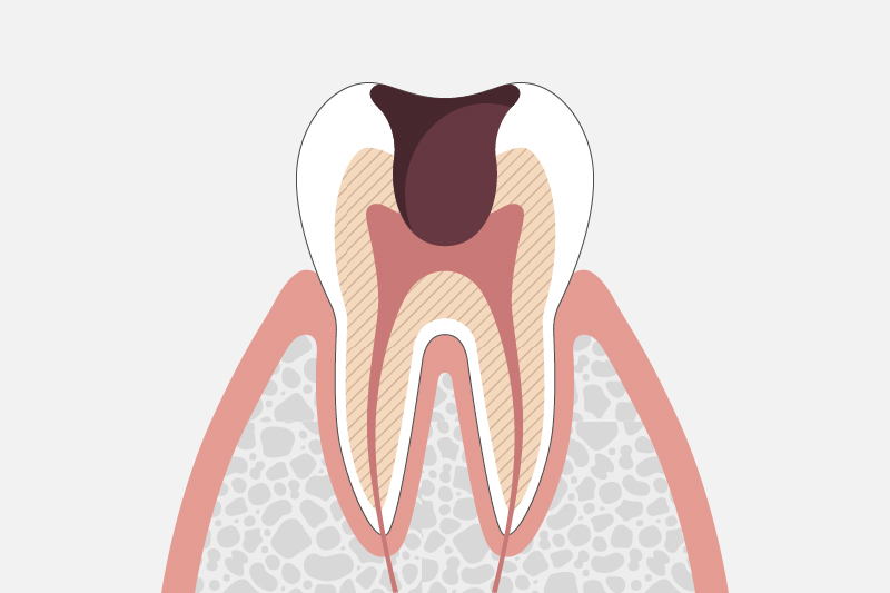 虫歯や虫歯治療・予防