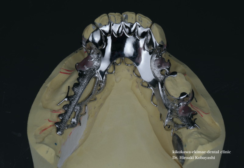 部分床義歯の金属フレーム