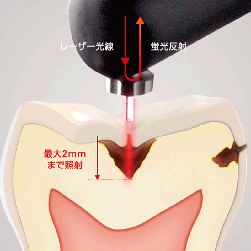 ダイアグノデント