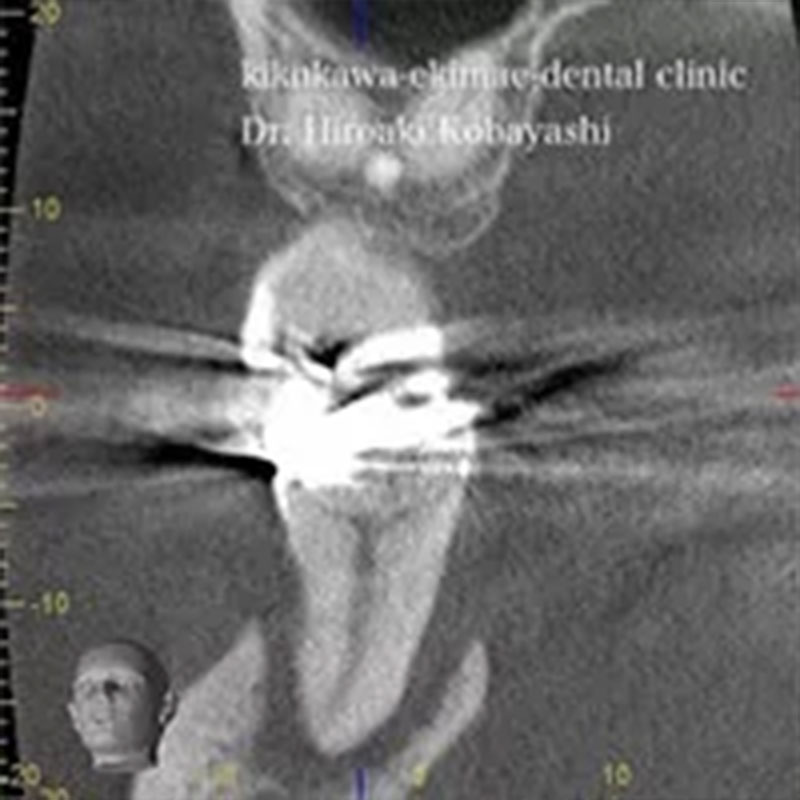 「米国式」根管治療症例