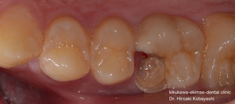 歯髄温存治療の症例