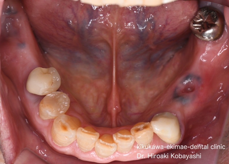 入れ歯・義歯の症例