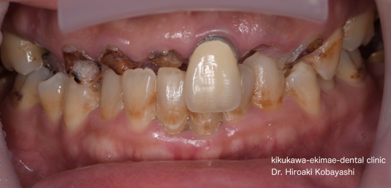入れ歯・義歯の症例