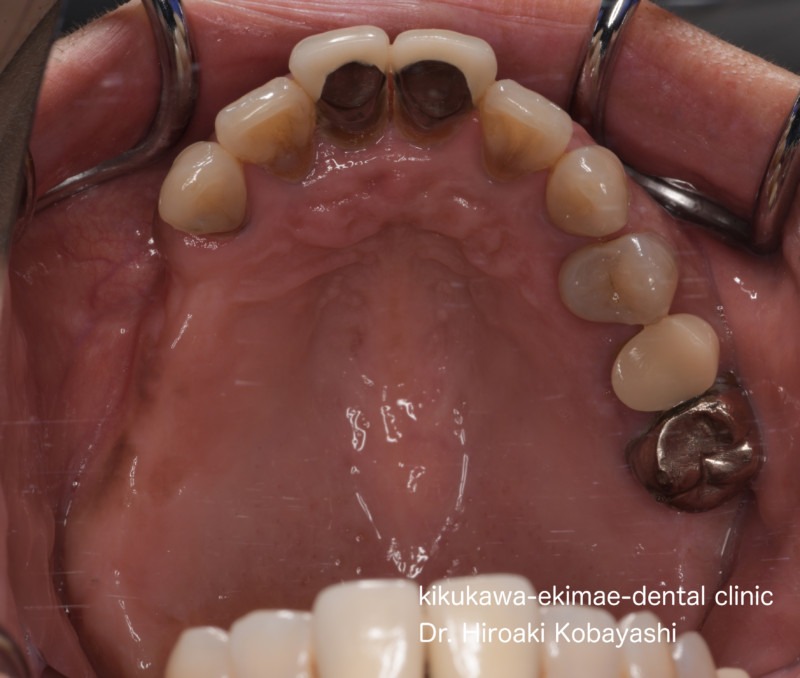 入れ歯・義歯の症例