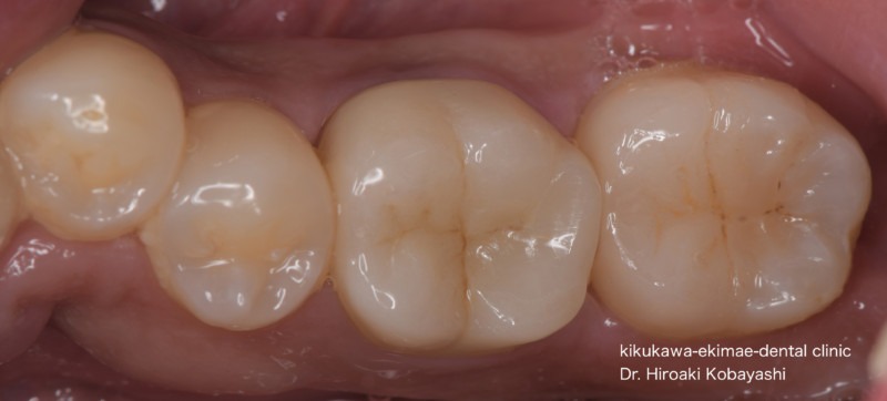 精密虫歯治療の症例