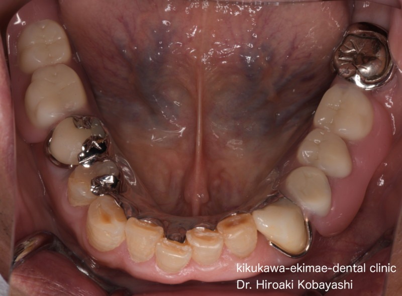 入れ歯・義歯の症例