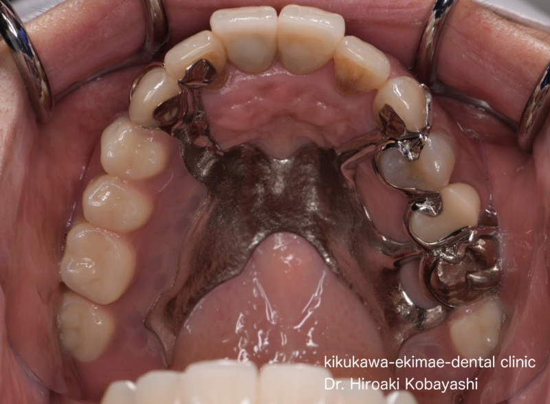 入れ歯・義歯の症例