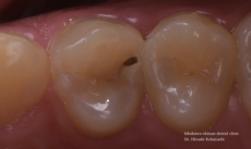 精密虫歯治療の症例