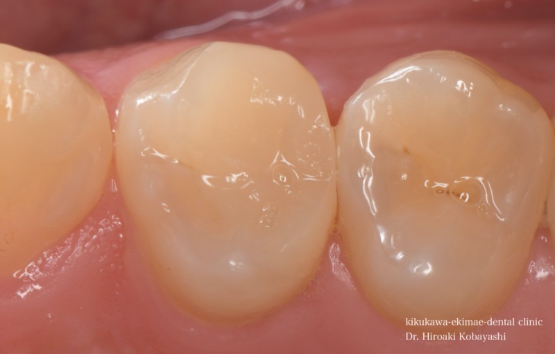 精密虫歯治療の症例