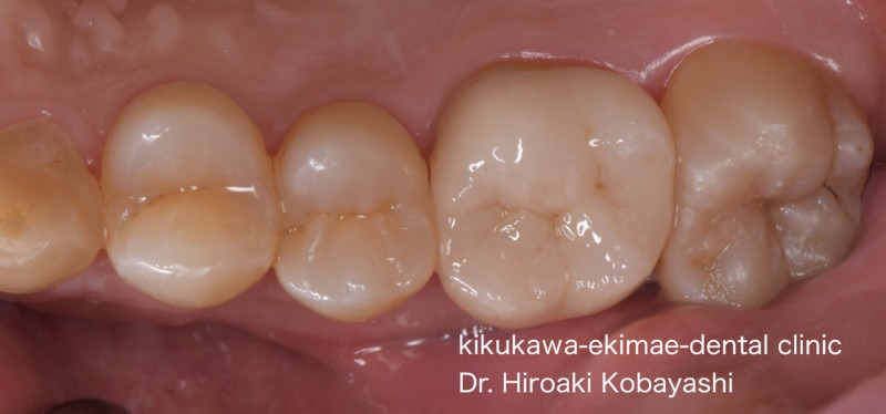 歯髄温存治療の症例