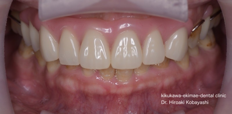 入れ歯・義歯の症例
