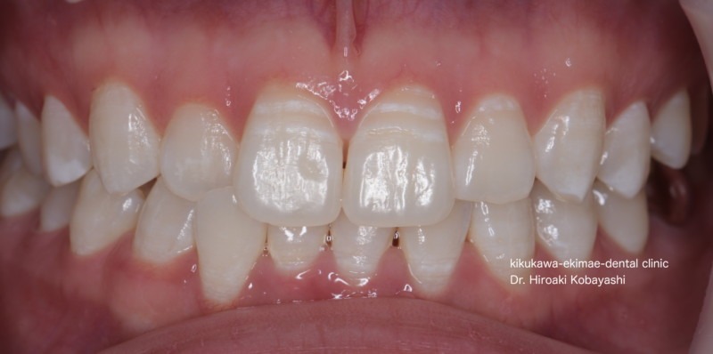 ホワイトスポット治療症例
