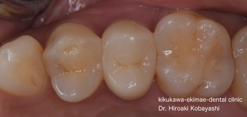 歯髄温存治療の症例