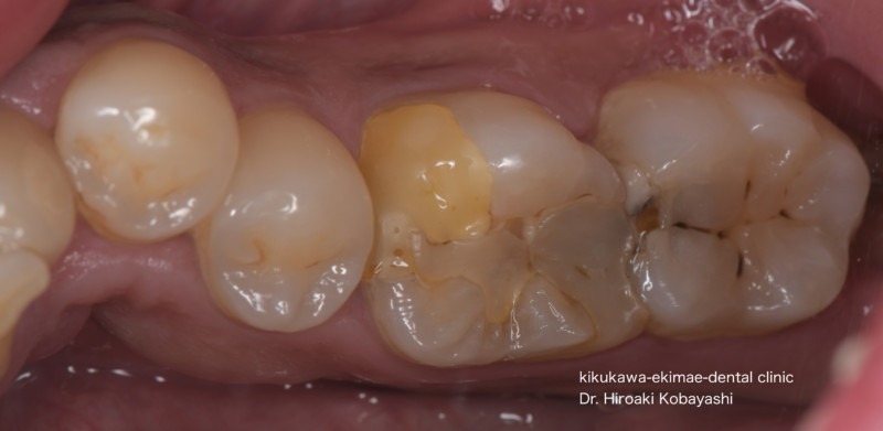 精密虫歯治療の症例