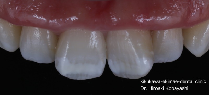 ホワイトスポット治療症例