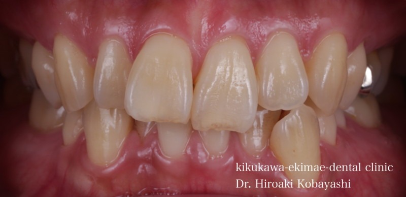 クリアアライナーの症例