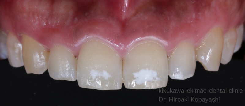 ホワイトスポット治療の症例