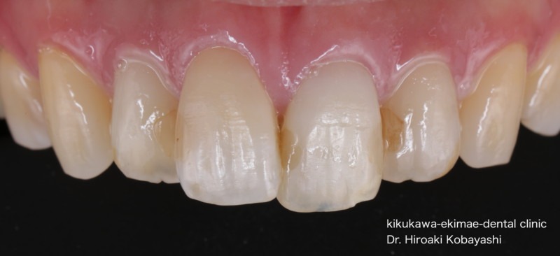 ホワイトスポット治療症例
