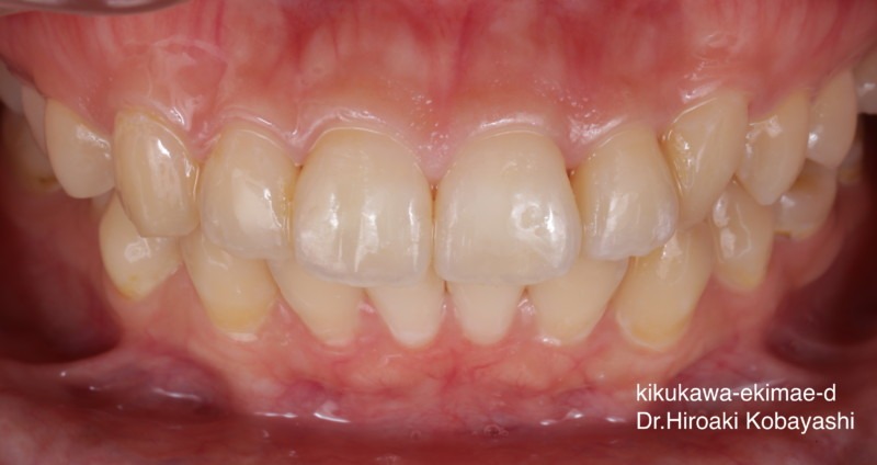 マウスピース矯正の症例