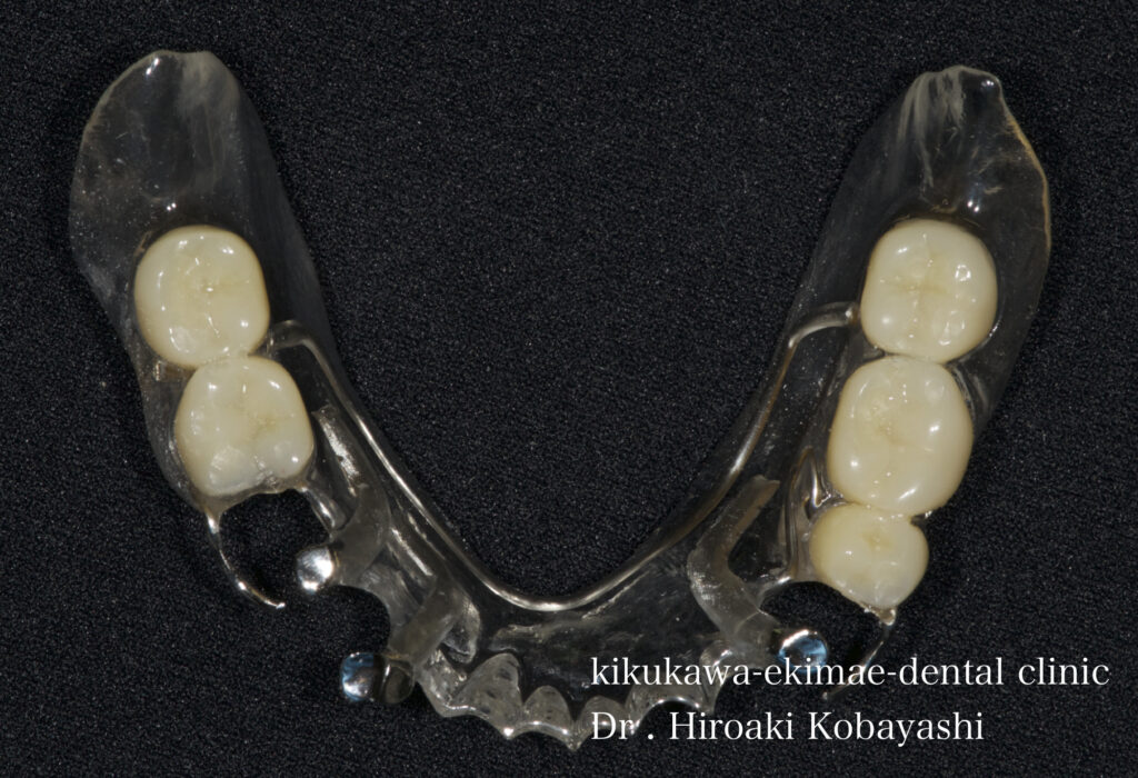 ２段階で製作する入れ歯　入れ歯治療　Case4｜東京／墨田区／江東区