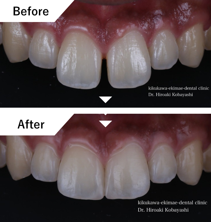 ダイレクトボンディングによる前歯(すきっ歯)の即日治療